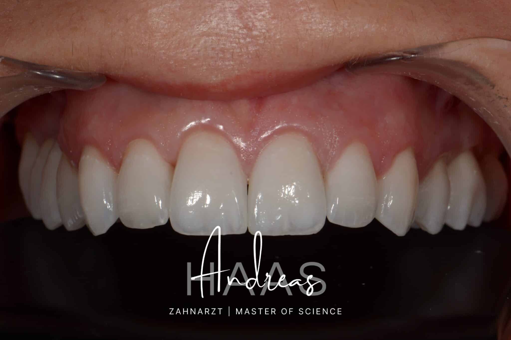 Nahaufnahme vollkeramisch versorgter Frontzähne einer Patientin – smileDentity Dreieich
