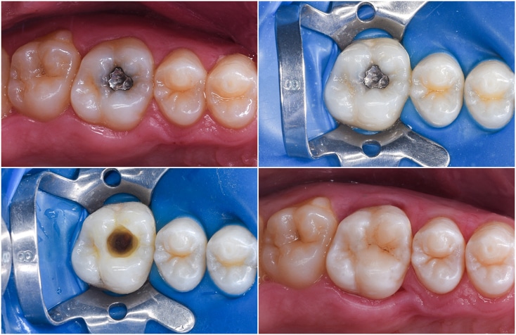 Sichere und schonende Amalgam-Entfernung bei smileDentity
