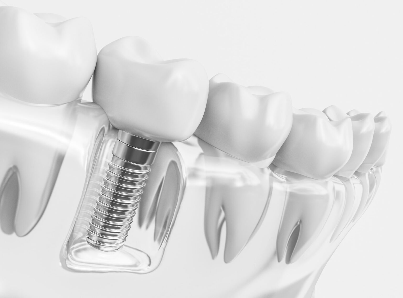 Implantologie – smileDentity Dreieich